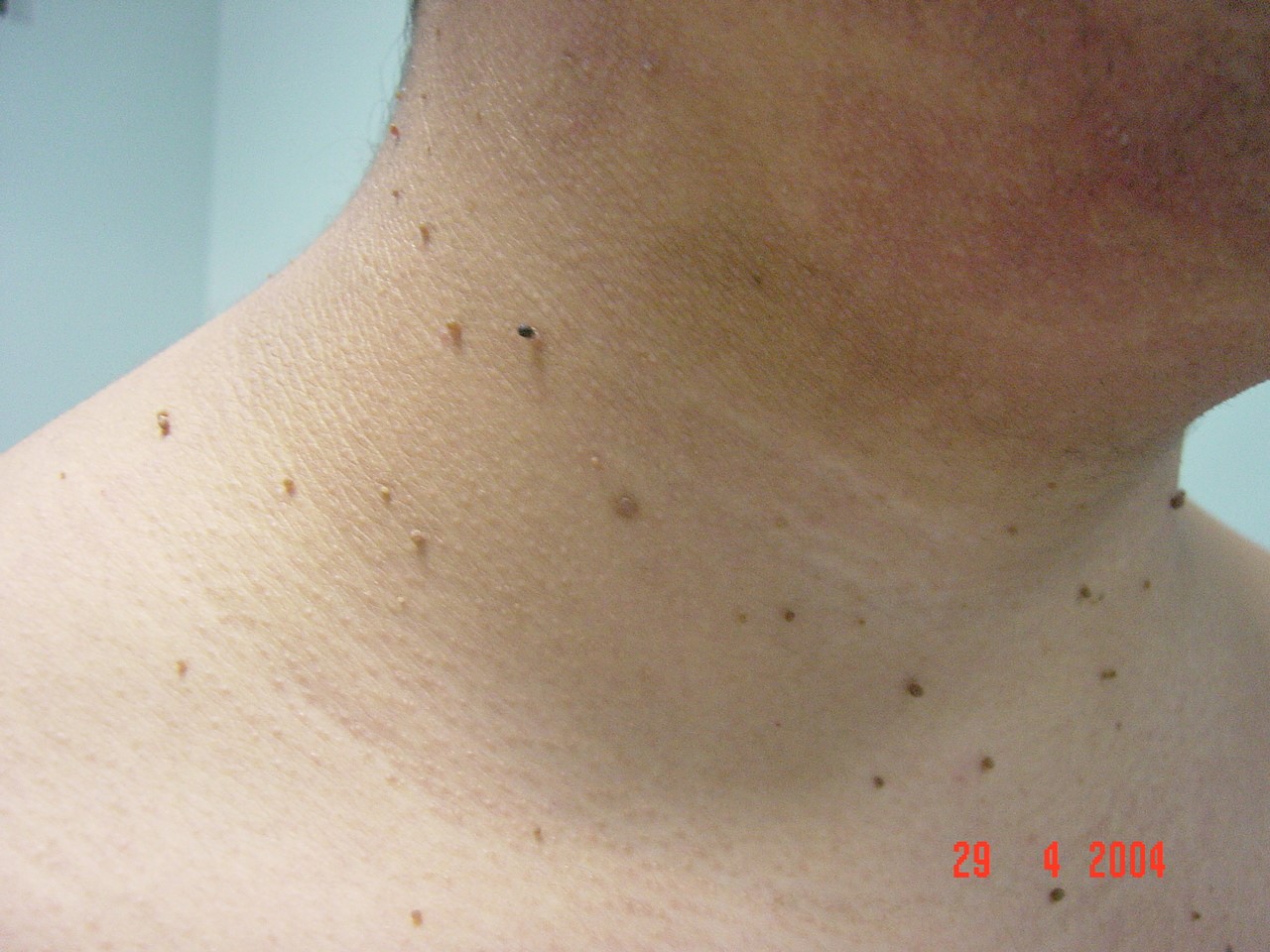 Alopecia Areata